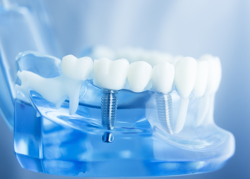 Monterey Coast Periodontics & Implant Dentistry (Carmel Location) - Periodontist in Carmel-By-The-Sea